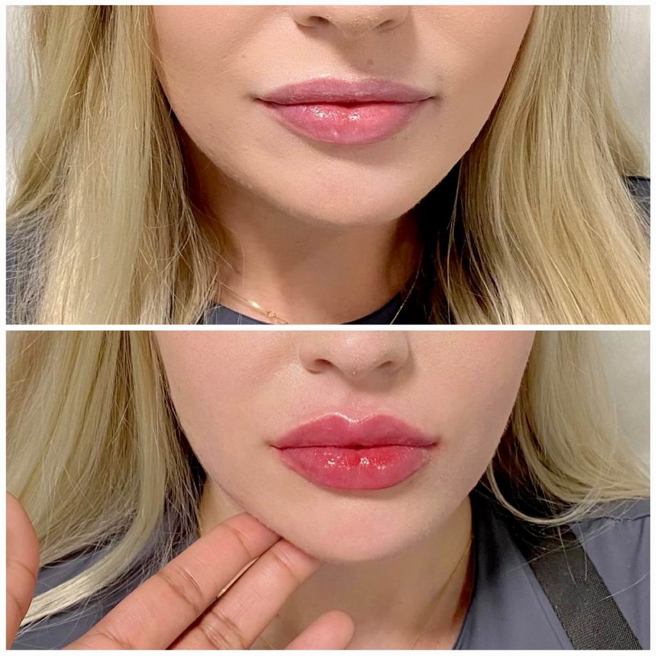 Kiknek ajánlható a Russian Lips ajakfeltöltési eljárás?